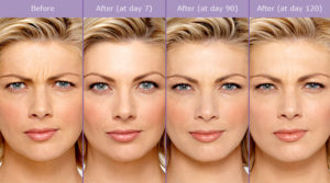 Botox Anti-Wrinkle Injectable | Board Certified Plastic Surgeon | El Paso